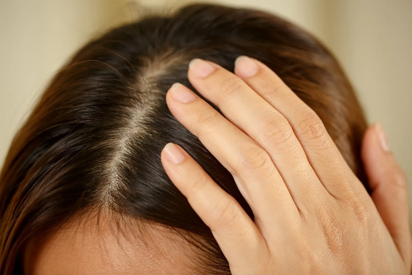 Scalp Eczema